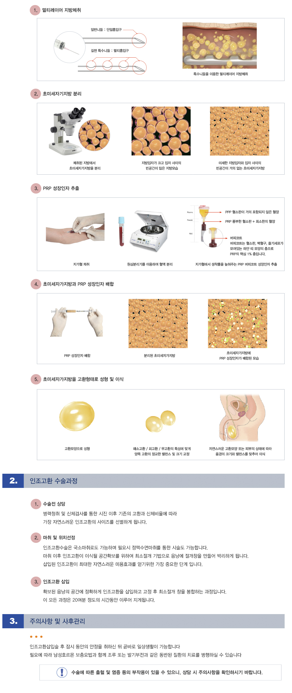 인조고환 수술